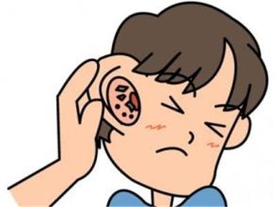 成都外耳道炎治疗哪家医院好