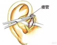 【成都】耳前瘘管治疗方法