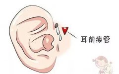 耳前瘘管有哪些症状表现
