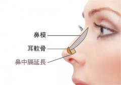成都鼻中隔偏曲的六大症状