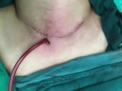 3天2台甲状腺肿瘤手术,成都仁品耳鼻喉专家妙手除“结”