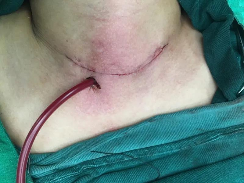 3天2台甲状腺肿瘤手术,成都仁品耳鼻喉专家妙手除“结”