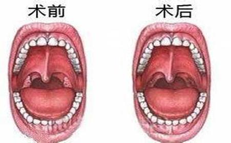 怎么样治疗扁桃体炎好的比较快