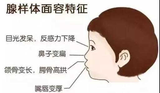 成都治疗腺样体肥大费用贵不贵呢