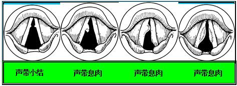声带小结的危害有哪些