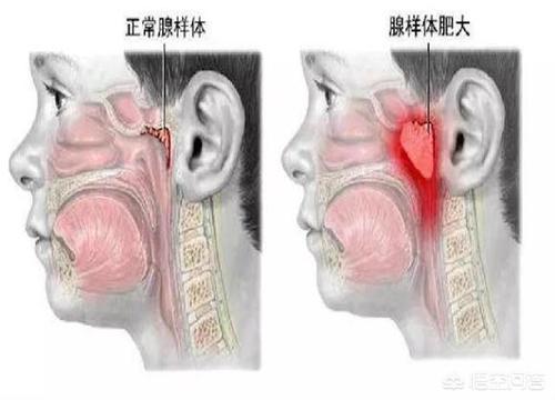 小儿腺样体肥大的危害有哪些