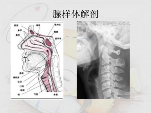 成都仁品怎么治疗腺样体肥大