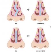 鼻中偏曲的病因是什么