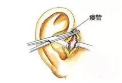 成都哪家医院可以治耳前瘘管?