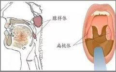 成都腺样体肥大治疗哪家医院好?