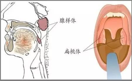 成都腺样体肥大治疗哪家医院好?