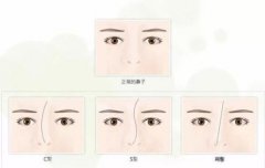 成都鼻中隔偏曲会对人体造成哪些危害??