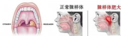 孩子睡觉磨牙流鼻涕是腺样体肥大导致的?