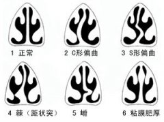 鼻中隔偏曲的治疗方法?