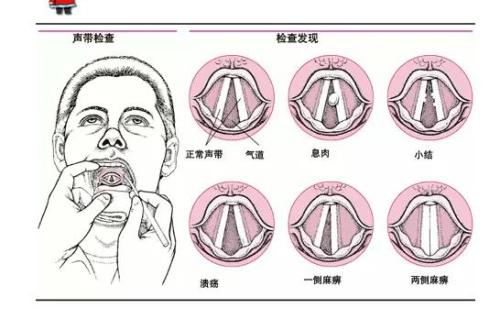 成都仁品治疗声带小结J1S怎么样?