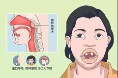 成都腺样体肥大的病因有哪些?