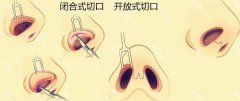 成都鼻中隔偏曲是哪些原因所造成的呢?